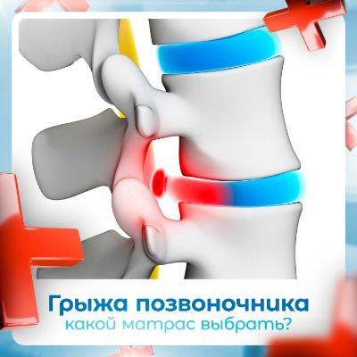 Какой матрас при грыже позвоночника